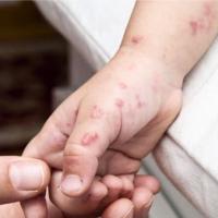 ΕΟΔΥ: Αύξηση περιστατικών Κοξάκι σε παιδιά και συστηνόμενα προληπτικά μέτρα